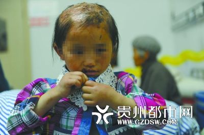 被燙傷的頭皮一直沒有愈合。