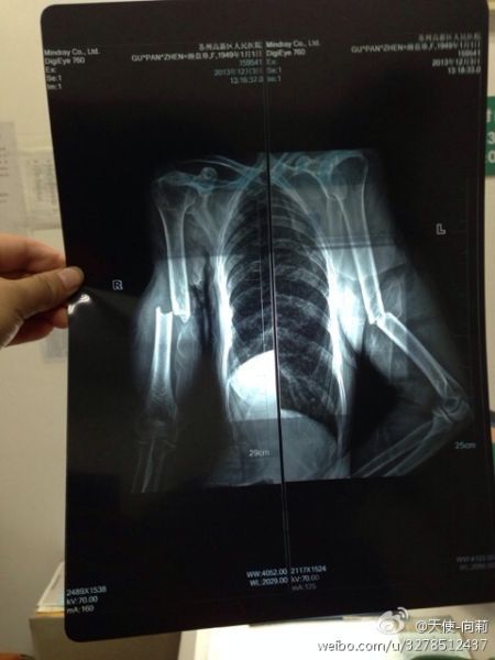 圖為微博上傳“范某某的妻子顧盤珍手被打斷。”