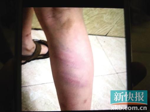 小宇腿部有明顯瘀痕。 翻拍自家屬手機(jī)