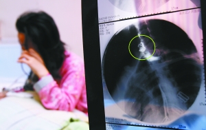 假牙上的鋼絲刺破食管，而薄薄的食道壁緊貼主動脈血管，極易造成血管破裂