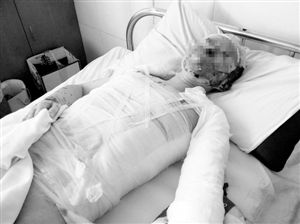 周小姐的頭、頸、軀干、四肢均被燒傷，其中面部燒傷最為嚴(yán)重。