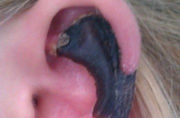 荷蘭女子旅游途中被蜘蛛咬，耳軟骨溶解變黑。