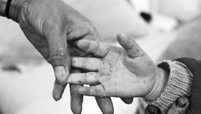 手足口病進(jìn)入高發(fā)季 河南省幼兒園開始每日晨檢