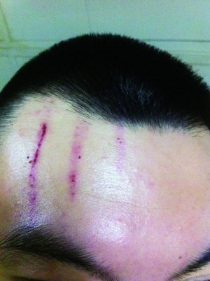 　2013年，被打者受傷照