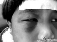 6月2日，網(wǎng)曝渭南市臨渭區(qū)一不滿5歲的女童遭奶奶毆打，眼圈青腫，引起網(wǎng)友關(guān)注，但孩子父母和爺爺均稱是摔倒導(dǎo)致。相關(guān)部門介入調(diào)查發(fā)現(xiàn)確為奶奶毆打所致，鑒于其身體原因已進(jìn)行批評教育。