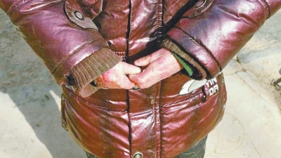 長(zhǎng)期受損的手指，已經(jīng)長(zhǎng)在了一起。