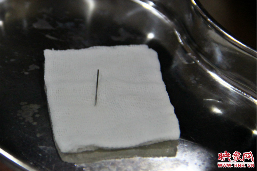 上午11點30分許，小龍腦中鋼針已經(jīng)成功取出。