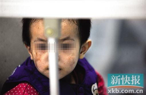 去年3月就能出院的小華(化名),目前還在廣州市婦兒醫(yī)療中心的PICU里住著。新快報記者 孫毅/攝