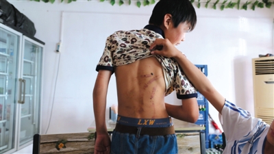 　昨日，奶西村，被打的小剛后背上條條瘀痕依然明顯。