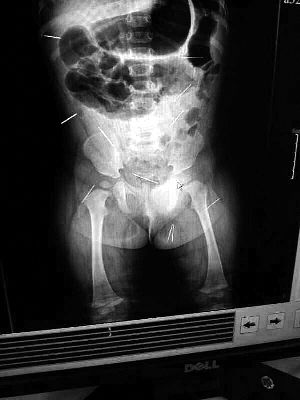 目前體內(nèi)的12根鋼針多分布在孩子的臀部，一根在腹部，其余3根在胸腔附近，其中一根很接近心臟