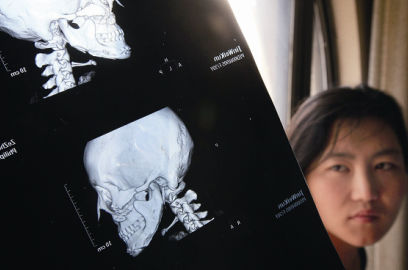 國(guó)內(nèi)醫(yī)院CT顯示，如今靳魏坤的鼻子假體是歪的，連下巴也是歪的