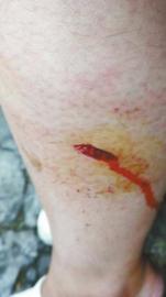 郭女士腿上被猴子咬的傷口。(受訪者供圖)