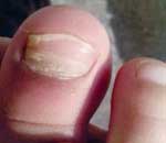 一幼兒園兒童“指甲異?！? title=