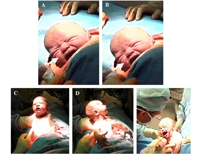 剖腹產寶寶出生瞬間